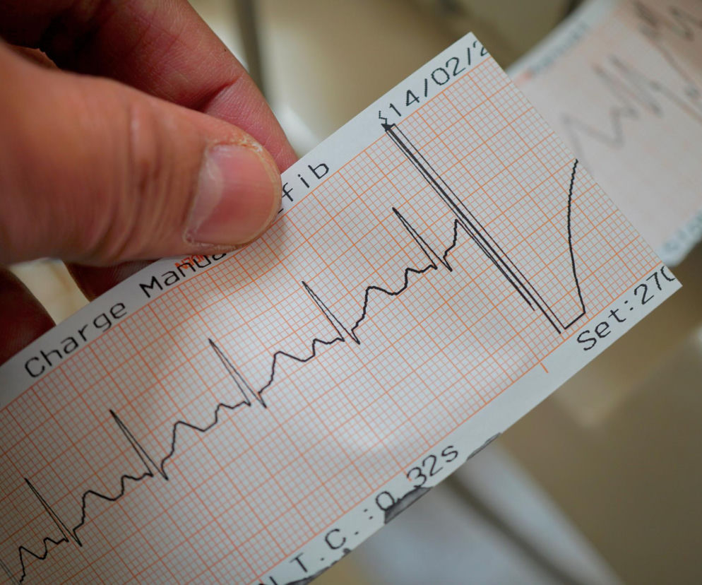 Dłoń trzyma wydruk EKG z widocznym rytmem serca na tle kratkowanego papieru medycznego, symbolizujący diagnostykę migotania przedsionków. O tej poważnej chorobie serca, zwiększającej ryzyko udaru, przeczytasz więcej na Poradnik Zdrowie.