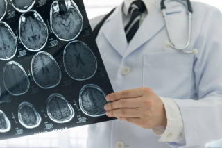 Autoimmunologiczne zapalenie mózgu. Rzadka choroba, która może przypominać zaburzenia psychiczne