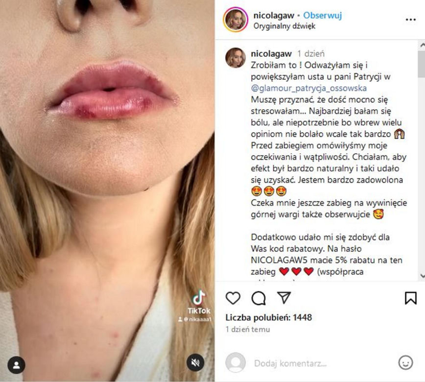 Nicola z "Rolnik szuka żony" powiększyła sobie usta