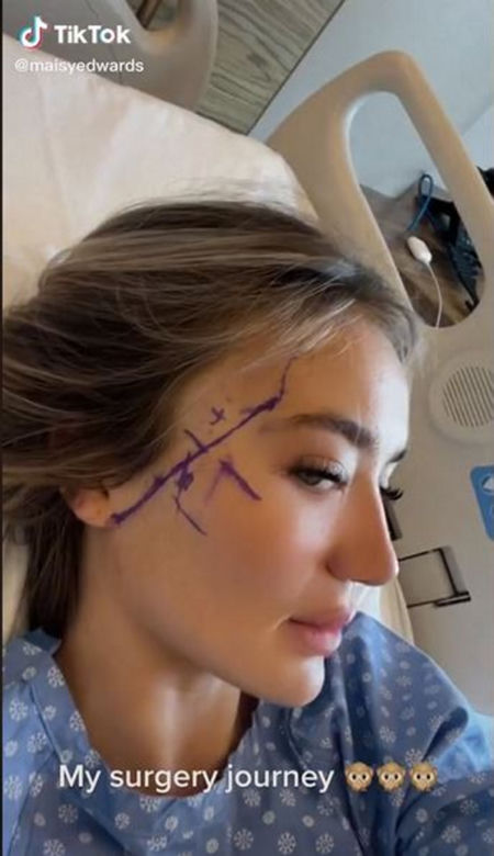 Znana influencerka pojechała do Turcji "zrobić" sobie nos. Wydała 50 tys. zł, fani bezlitośni: "Jest gorzej"