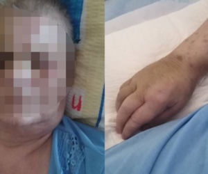 Śląskie. KOSZMAR pacjentki w szpitalach? Miała siniaki i krwiaki [DRASTYCZNE ZDJĘCIA]