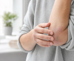 Ten objaw bywa mylony z łupieżem. Łuszczyca często rozwija się także poza skórą