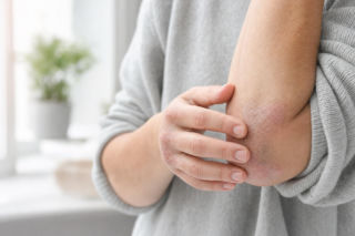 Ten objaw bywa mylony z łupieżem. Łuszczyca często rozwija się także poza skórą