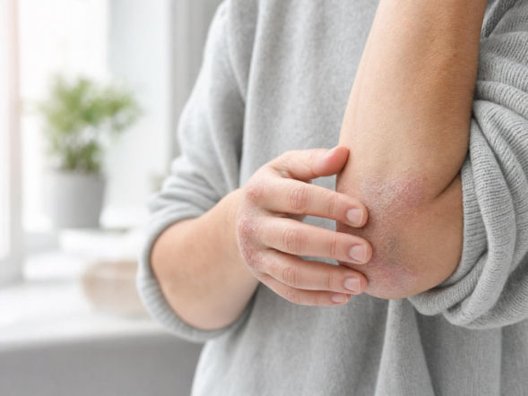 Ten objaw bywa mylony z łupieżem. Łuszczyca często rozwija się także poza skórą