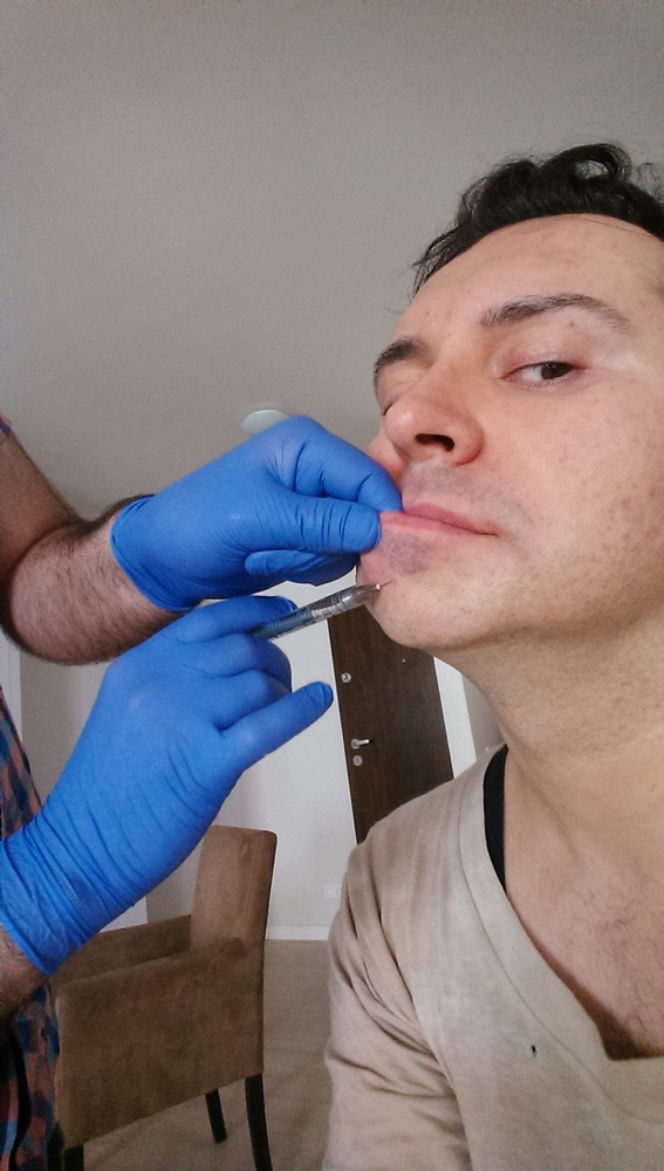 Michał Witkowski wstrzykuje sobie botoks i powiększa usta!