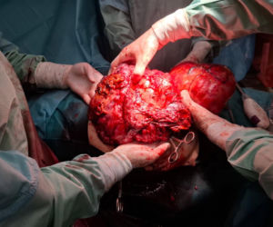 Sosnowieccy lekarze wycięli wielkiego guza