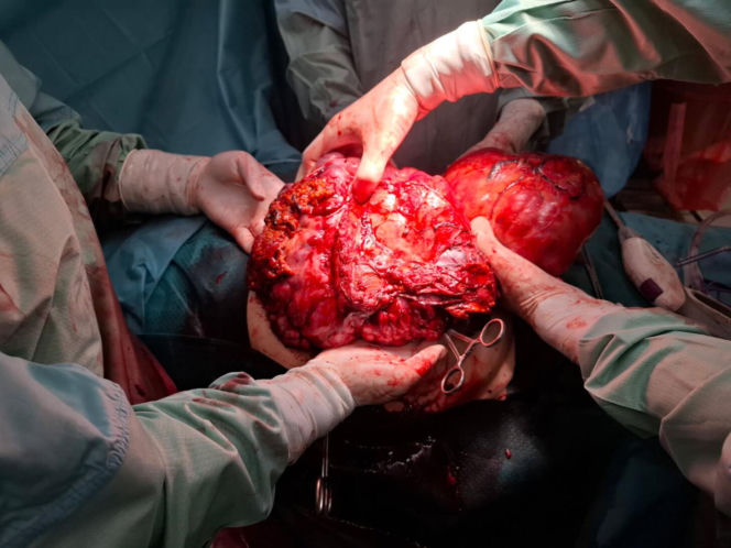 W Zagłębiowskim Centrum Onkologii usunięto gigantycznego guza