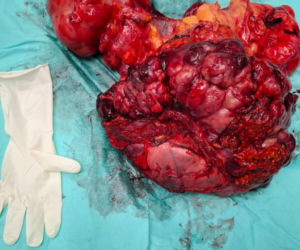 Sosnowieccy lekarze wycięli wielkiego guza