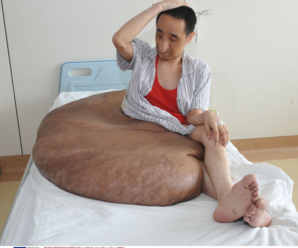 Mężczyzna z gigantycznym guzem! Narośl ważyła 107 kilogramów!