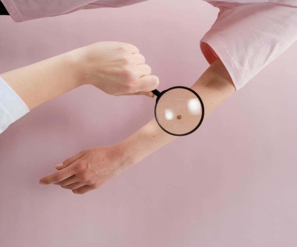 Dermatolog w białym kitlu, używając lupy, dokładnie bada pieprzyk na ramieniu pacjenta w różowej koszulce, szukając objawów czerniaka zgodnie z zasadą ABCDE. O tym, jak rozpoznać niepokojące zmiany na skórze, przeczytasz na Poradnik Zdrowie.