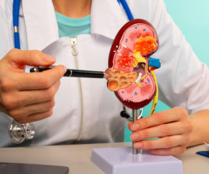 Kamienie nerkowe dotykają miliony osób. Tych 5 łatwych trików może znacząco obniżyć ryzyko ich powrotu