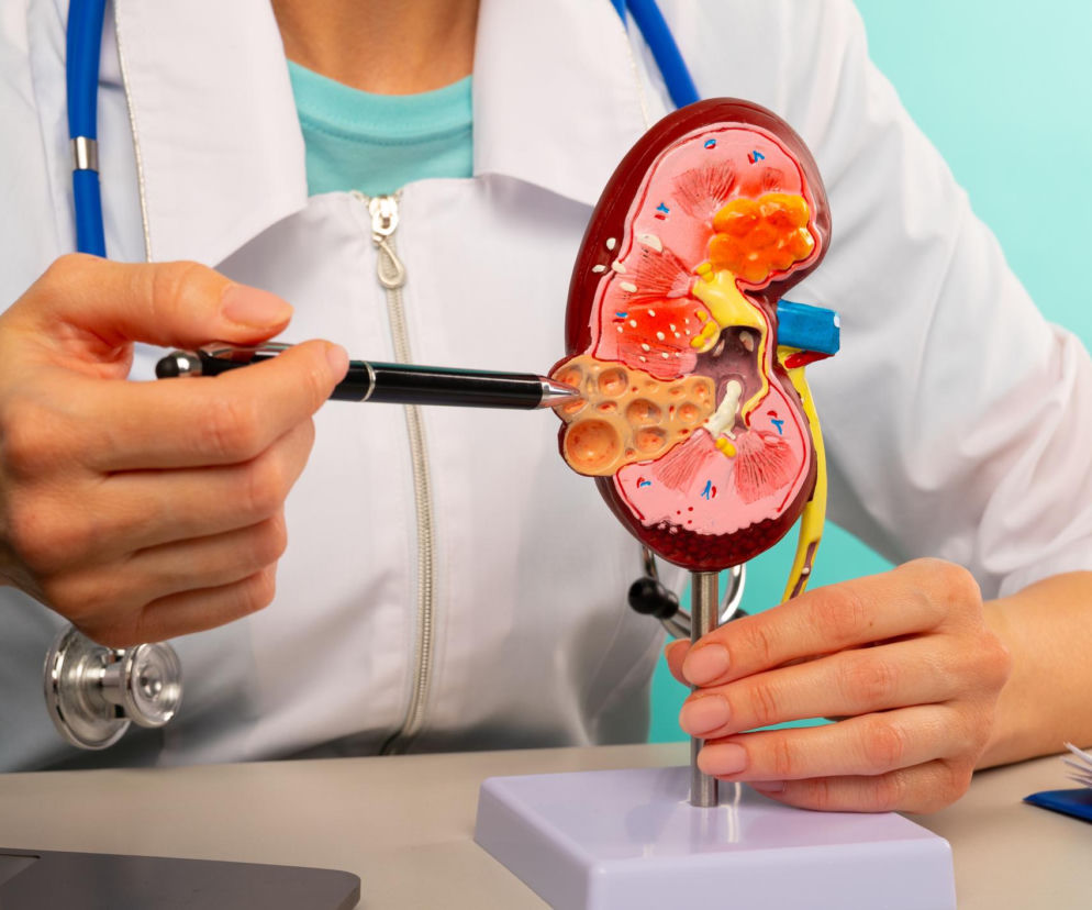 Kamienie nerkowe dotykają miliony osób. Tych 5 łatwych trików może znacząco obniżyć ryzyko ich powrotu