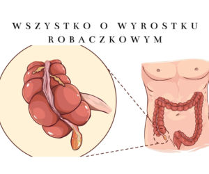 Wszystko o wyrostku robaczkowym