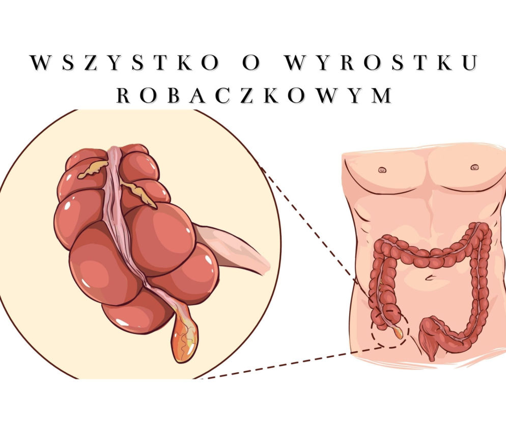 Wszystko o wyrostku robaczkowym