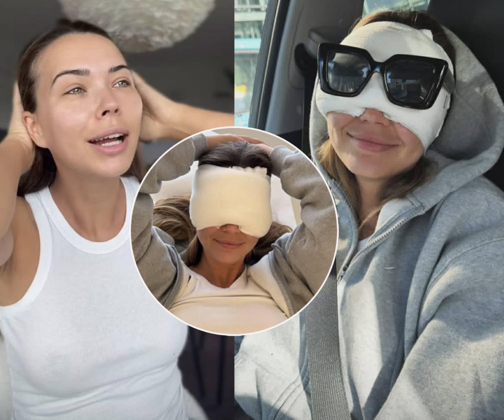 Sandra Kubicka przed i po operacji powiek. Na wstawce celebrytka z opatrunkiem na twarzy. O efektach przeczytasz na SE.