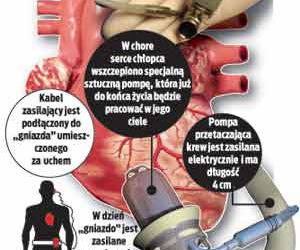 Sztuczne serce