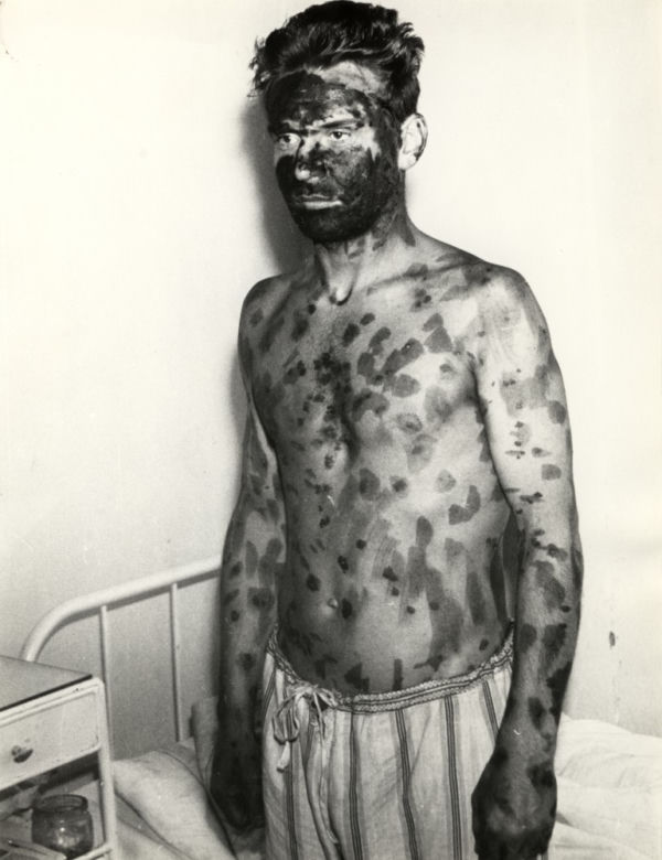 Epidemia czarnej ospy we Wrocławiu. Tak to wyglądało 60 lat temu [ZDJĘCIA] 