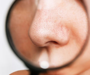 Zaskórniki nie dają spokoju? Poznaj bezpieczne sposoby na oczyszczenie porów