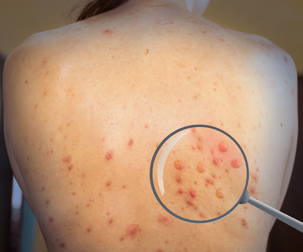  Małpia ospa jednak groźna? Zakażone dziecko leży na intensywnej terapii. Grozi nam epidemia?