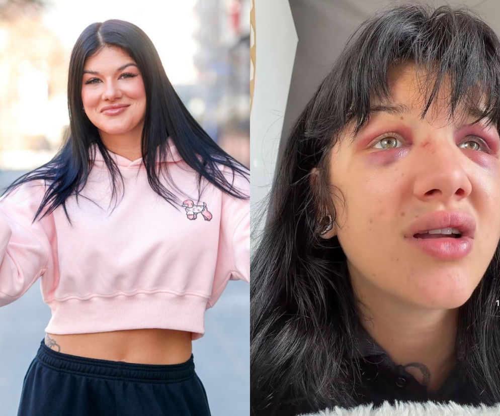 Dominika Rybak w różowej bluzie, a obok na wstawce jej twarz z siniakami po walce. O jej kontuzji przeczytasz na Eska.