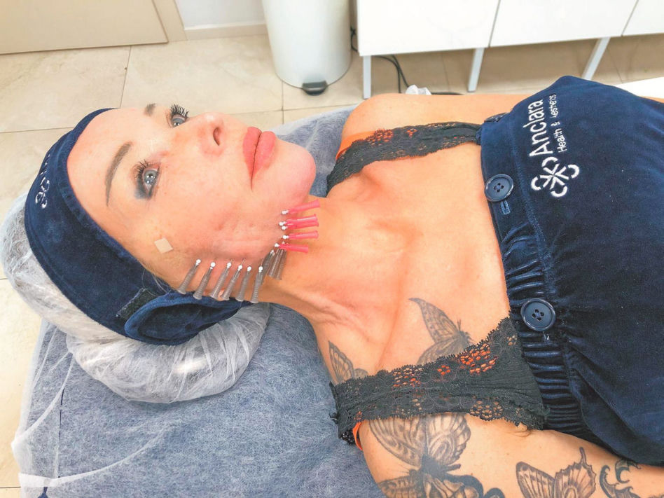 Eva Minge wbiła sobie 46 igieł w twarz