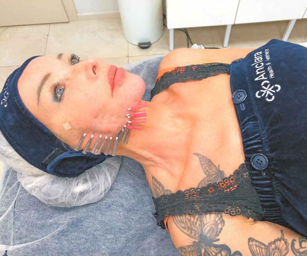 Eva Minge wbiła sobie 46 igieł w twarz