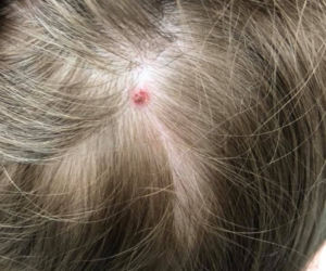  5-latka pogryziona przez kleszcza. Ma problem z mową, nie może chodzić