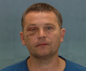 Wydrukowali mu nowe kości twarzy